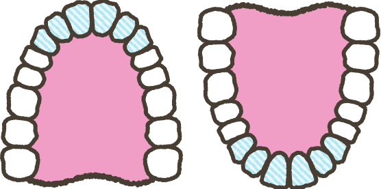 簡易型マウスピース