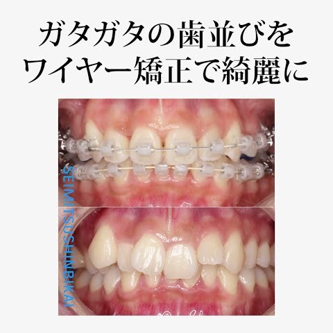 【20代女性】ガタガタの歯並びをワイヤー矯正で綺麗に