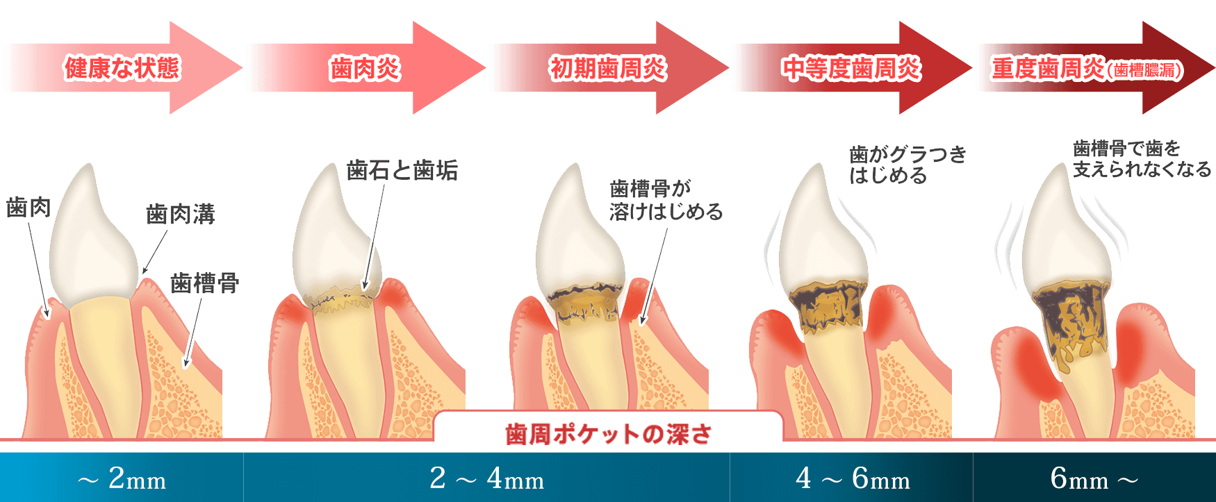 歯周病の状態