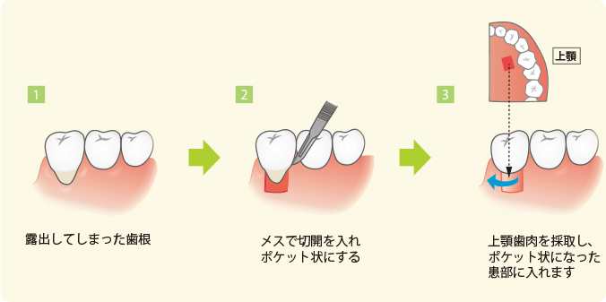 歯ぐき移植術