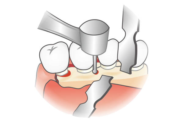 骨外科処置(骨を削る処置)による骨の平坦化