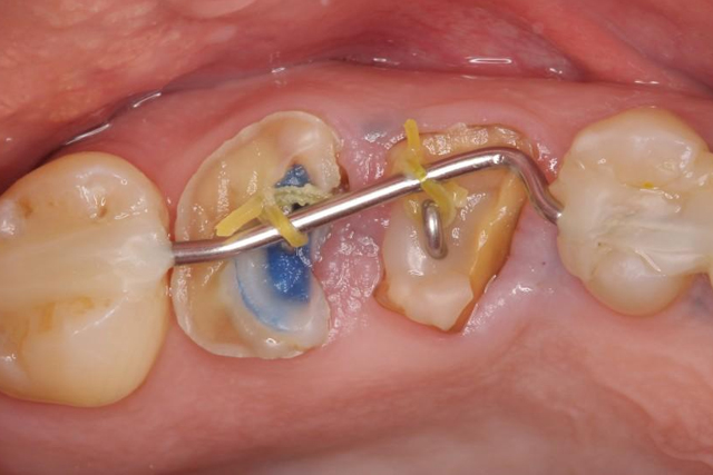 歯肉歯槽粘膜の治療
