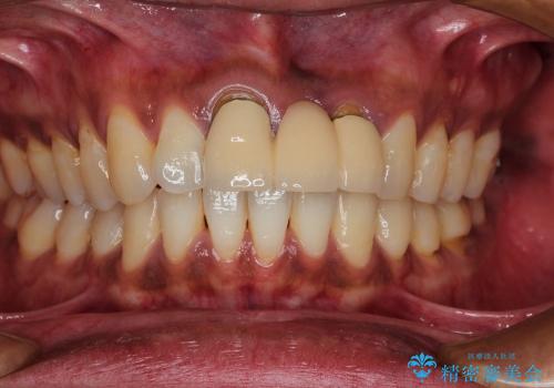 前歯のメタルボンドブリッジをオールセラミックブリッジへ(30代男性)の症例 治療前