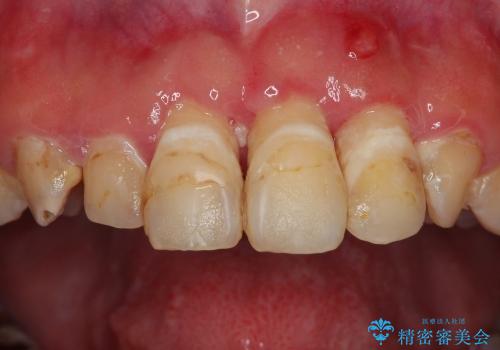 交通事故後の前歯セラミック治療(30代女性)の症例 治療前