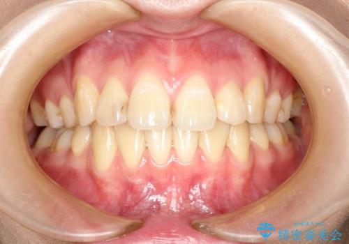 叢生(でこぼこ) 4本抜歯(20代女性)の症例 治療後