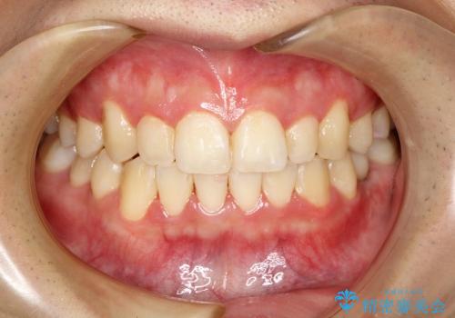 叢生(でこぼこ) 乳歯抜歯(20代男性)の症例 治療後