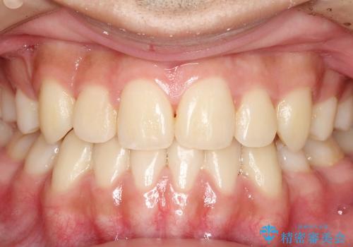 叢生(八重歯) 3本抜歯(10代男性)の症例 治療後