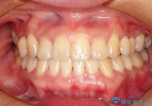 叢生(でこぼこ) 非抜歯、マイクロインプラント(30代女性)の症例 治療後