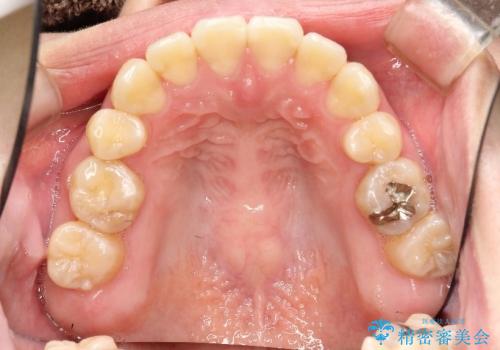 叢生(でこぼこ) 2本抜歯(30代女性)の治療後
