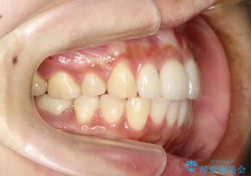 叢生(でこぼこ) 2本抜歯(30代女性)の治療後