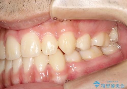 叢生(八重歯) 3本抜歯(10代男性)の治療後