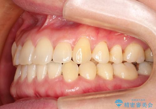 叢生(でこぼこ) 非抜歯、マイクロインプラント(30代女性)の治療後