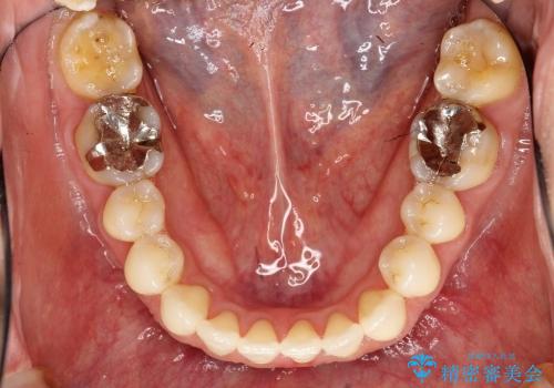 叢生(でこぼこ) 非抜歯、ディスキング(30代女性)の治療後