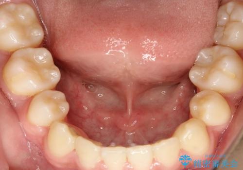 叢生(八重歯) 3本抜歯(10代男性)の治療後
