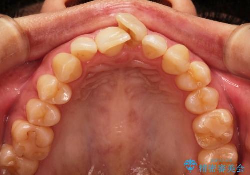 叢生(でこぼこ) 抜歯2本(30代女性)の治療前