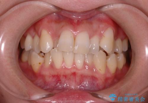 叢生(でこぼこ) 抜歯あり(20代女性)の症例 治療前