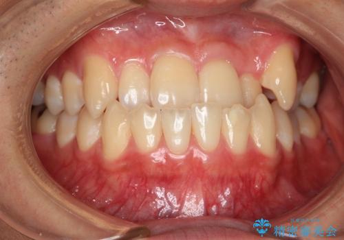 反対咬合 非抜歯(20代男性)の症例 治療前