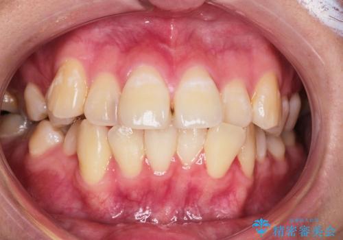 叢生(でこぼこ) 4本抜歯(20代女性)の症例 治療前