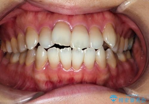 叢生(でこぼこ) 抜歯4本(30代女性)の症例 治療前