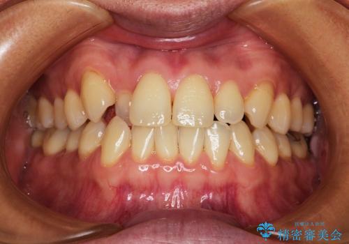 叢生(でこぼこ) 非抜歯、ディスキング(30代女性)の症例 治療前