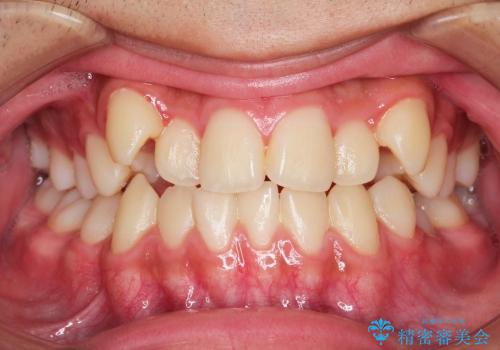 叢生(八重歯) 3本抜歯(10代男性)の症例 治療前