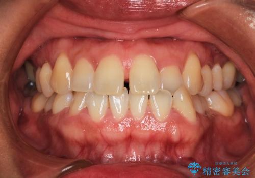 叢生(でこぼこ) 非抜歯、マイクロインプラント(30代女性)の症例 治療前