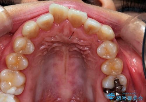 叢生(でこぼこ) 抜歯4本(30代女性)の治療前