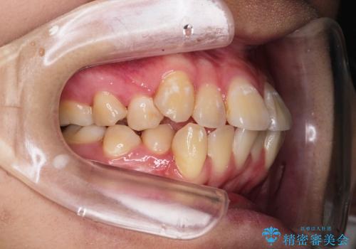 叢生(でこぼこ) 4本抜歯(20代女性)の治療前