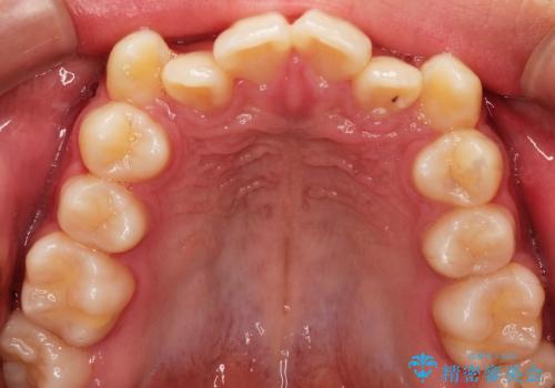 叢生(八重歯) 3本抜歯(10代男性)の治療前