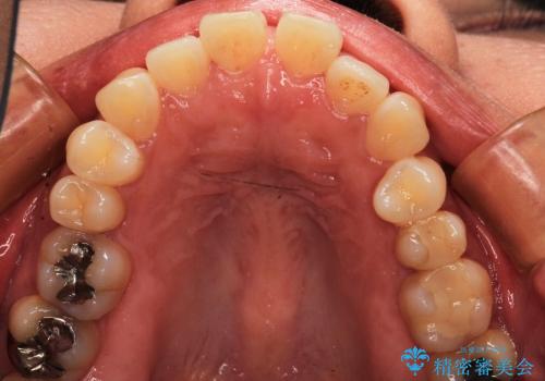 叢生(でこぼこ) 非抜歯、マイクロインプラント(30代女性)の治療前