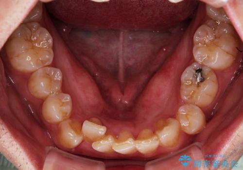 叢生(でこぼこ) 乳歯抜歯(20代男性)の治療前