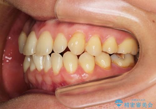 叢生(でこぼこ) 非抜歯、ディスキング(30代女性)の治療前
