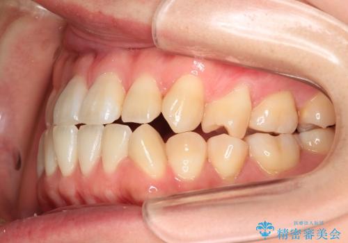 叢生(でこぼこ) 2本抜歯(30代女性)の治療前