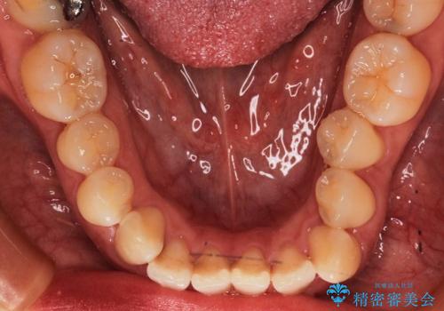 叢生(でこぼこ) 非抜歯、マイクロインプラント(30代女性)の治療前