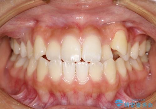 叢生(八重歯) 4本抜歯(10代女性)の症例 治療前