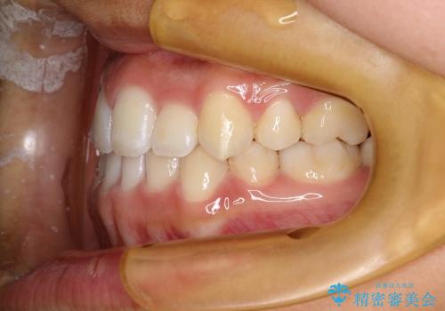 叢生(八重歯) 4本抜歯(10代女性)の治療後