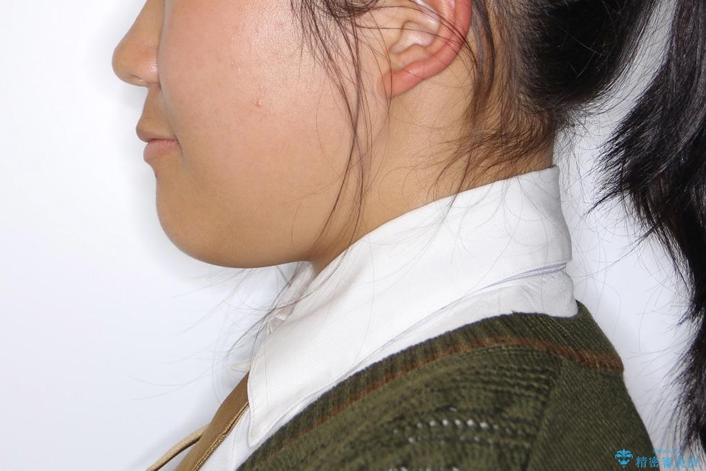 叢生(八重歯) 4本抜歯(10代女性)の治療後(顔貌)