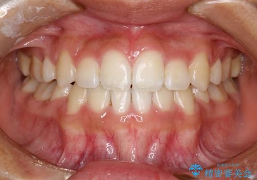 叢生(八重歯) 4本抜歯(10代女性)の症例 治療後