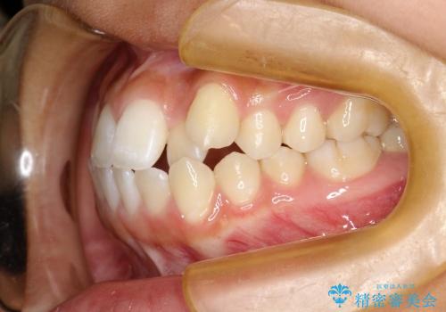 叢生(八重歯) 4本抜歯(10代女性)の治療前