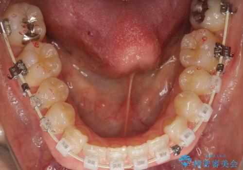 叢生(でこぼこ) 非抜歯、マイクロインプラント(30代女性)の治療中