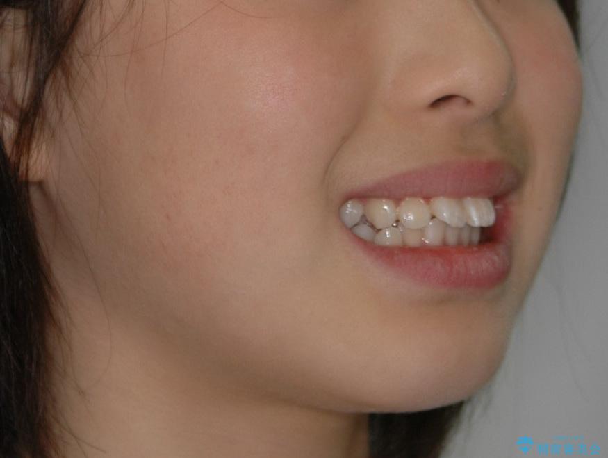 出っ歯(上顎前突)・ペンデュラム装置・メタル・小児矯正・非抜歯の治療前（顔貌）
