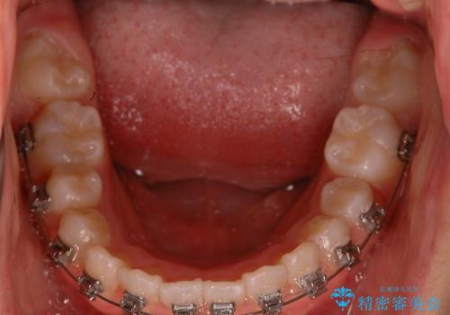 出っ歯(上顎前突)・ペンデュラム装置・メタル・小児矯正・非抜歯の治療中