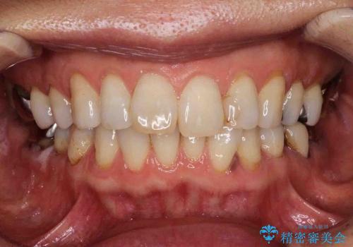 前歯のがたがた　歯を抜かない矯正治療　60代でもできますの治療前