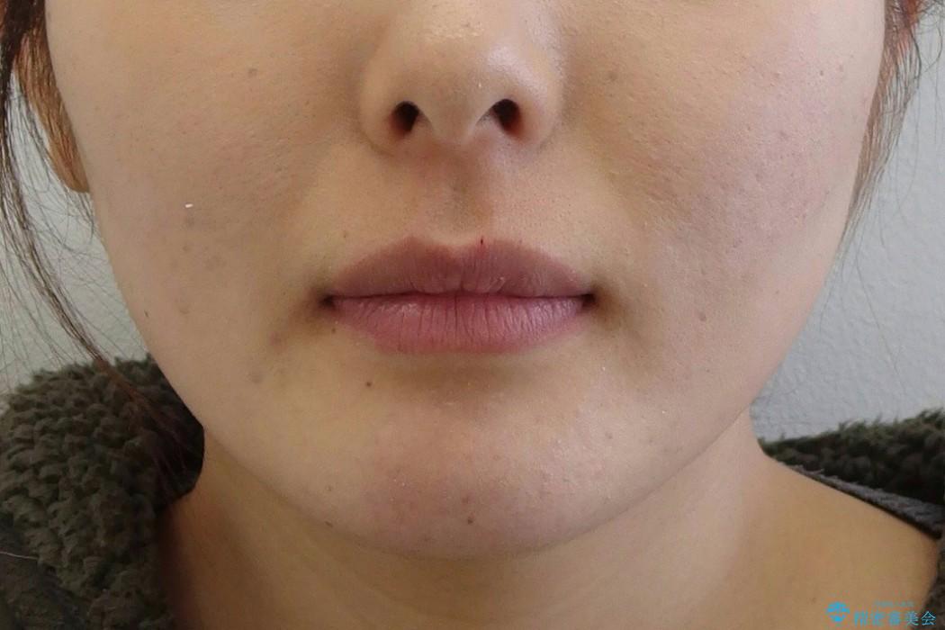 [20代女性] 前歯のがたがた　歯を抜かない矯正治療の治療前（顔貌）