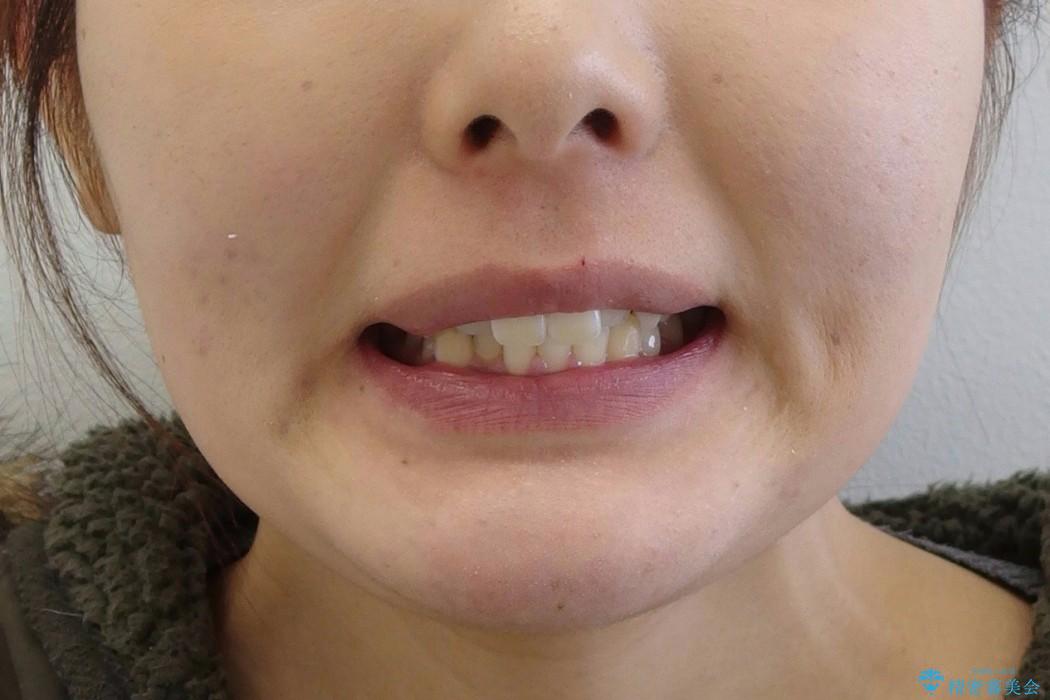 [20代女性] 前歯のがたがた　歯を抜かない矯正治療の治療前（顔貌）
