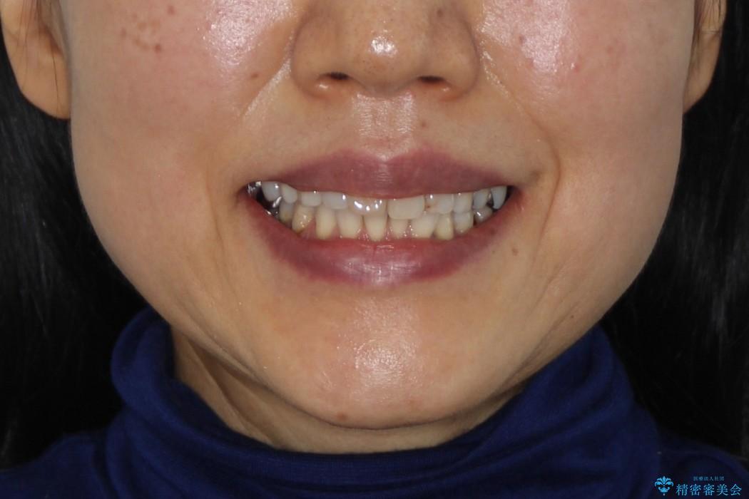 前歯のがたがた　歯を抜かない矯正治療　60代でもできますの治療前（顔貌）