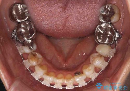 前歯のがたがた　歯を抜かない矯正治療　60代でもできますの治療中