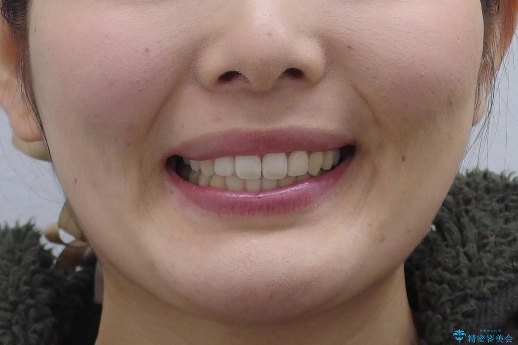 [20代女性] 前歯のがたがた　歯を抜かない矯正治療の治療後（顔貌）