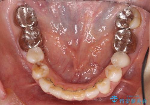 前歯のがたがた　歯を抜かない矯正治療　60代でもできますの治療後