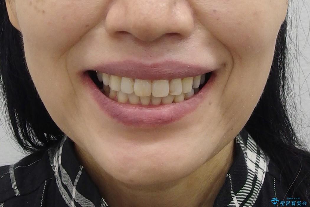 前歯のがたがた　歯を抜かない矯正治療　60代でもできますの治療後（顔貌）
